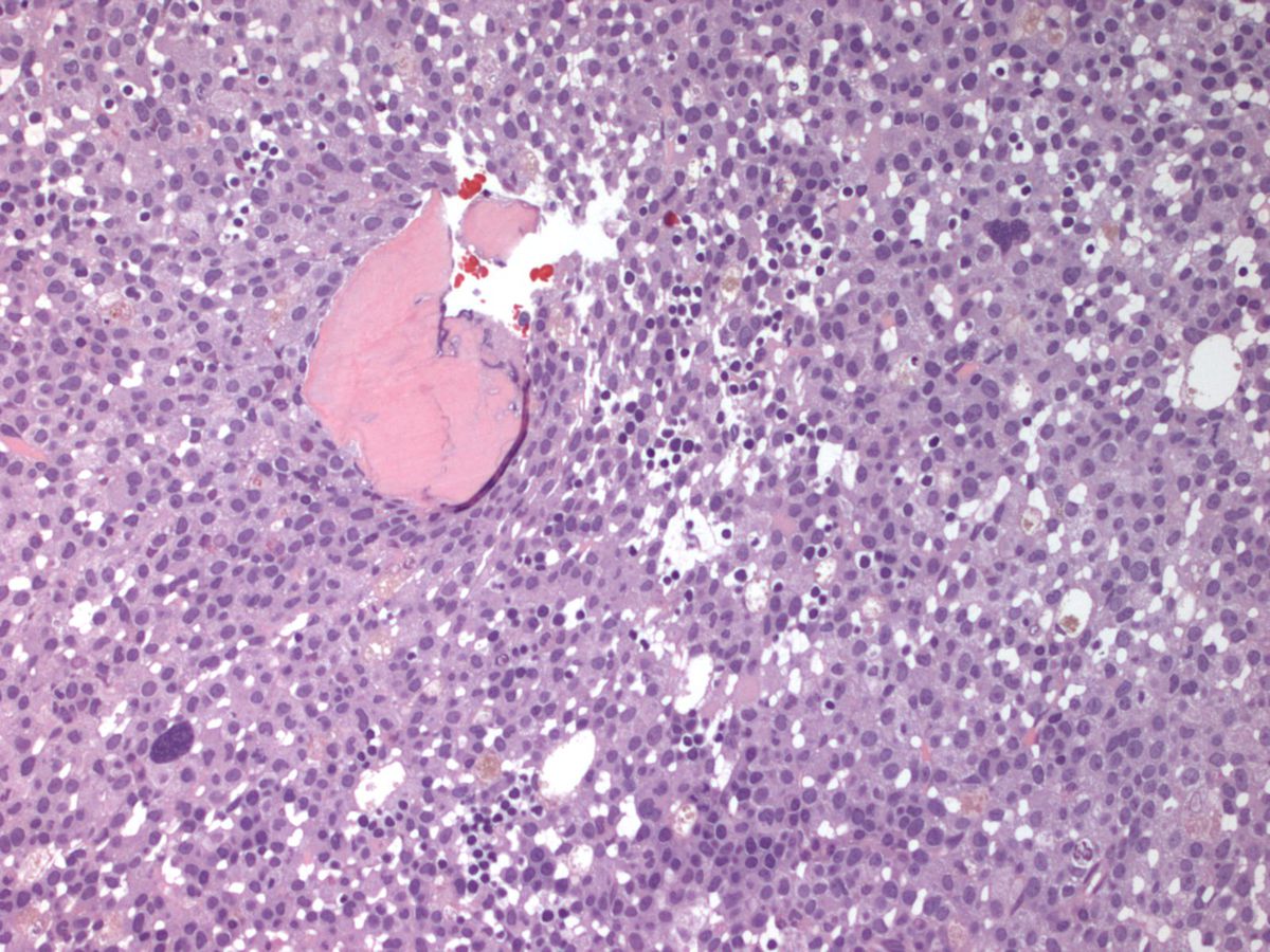 bone marrow biopsy 400x